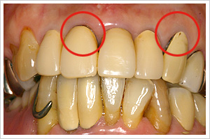 サージカルガイド