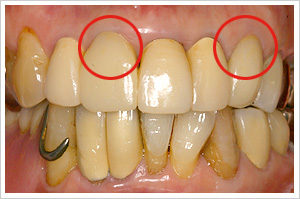 サージカルガイド